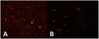 Protein Expression of PTTG-1, OCT-4, and KLF-4 in Seminoma: A Pilot Study